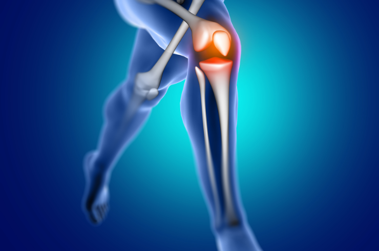 Knee Replacement